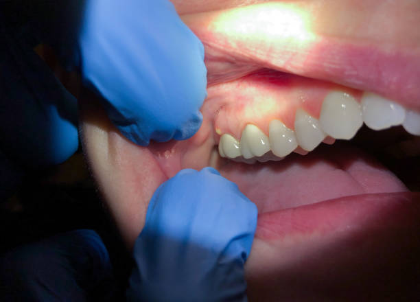 Best Emergency Dental Filling Replacement  in Bargersville, IN